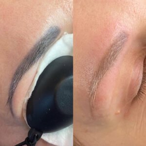 Laser PMU Removal