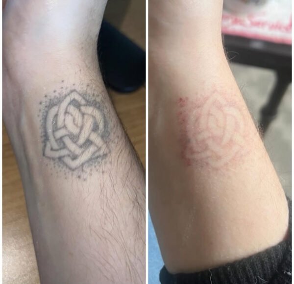 Laser Tattoo Removal